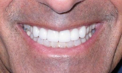 Crown-Bridge-Bleaching-After-Image