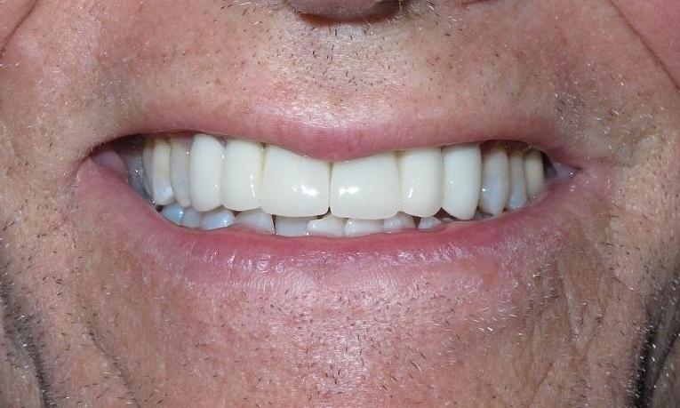 Crown-Bridge-and-K-R-Whitening-After-Image