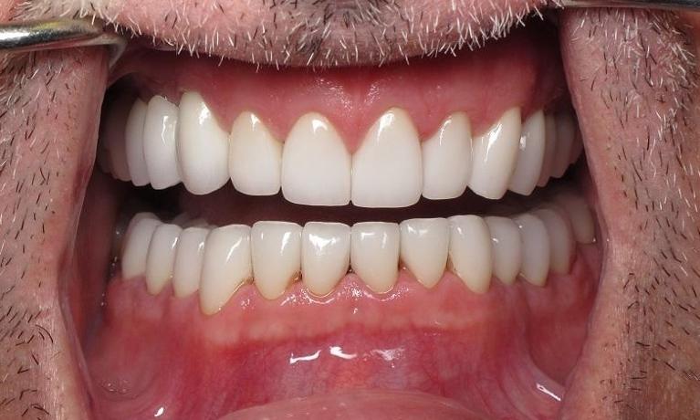 Full-Mouth-Rehabilitation-After-Image