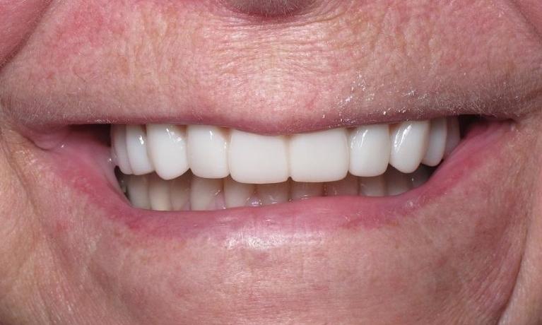 Implant-Supported-Denture-After-Image