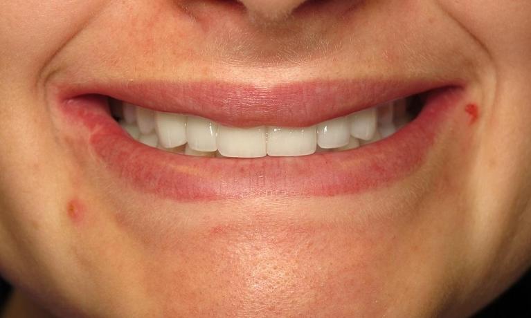 Implants-and-Teeth-Whitening-After-Image