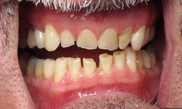 Full-Mouth-Rehabilitation-Before-Image