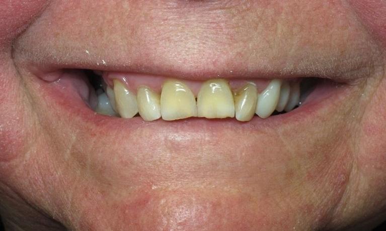 Implant-Supported-Denture-Before-Image