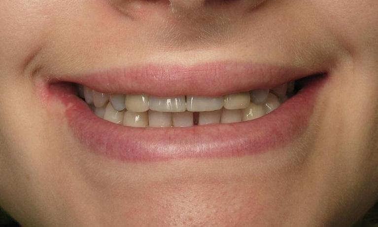 Implants-and-Teeth-Whitening-Before-Image
